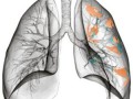 Fagyasztással kezelhető a tüdőrák?
