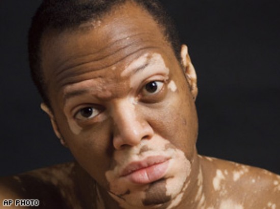 vitiligo betegség