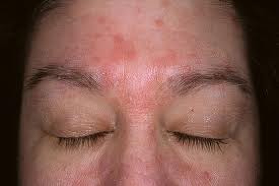 seborrhoeás dermatitis fejbőr pikkelysömör kezelése népi gyógymódokkal szódával