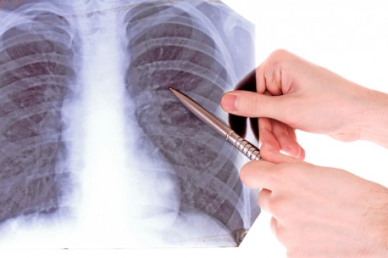 Tüdő- és légúti megbetegedések - Tüdőgyulladás