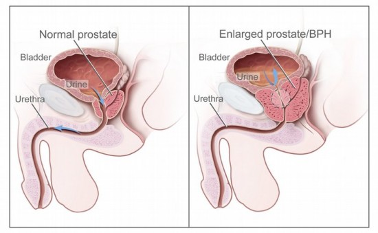 Libidó és prosztatitis A prosztata gyulladása és a kezelés módszerei
