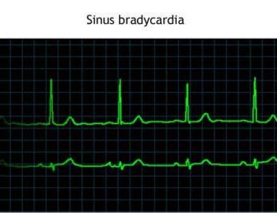 egészségügyi pulzusszám grafikon