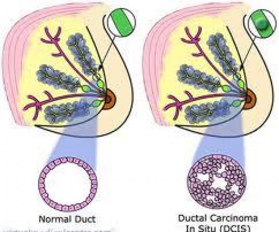 DCIS - Ductal Carcinoma In Situ