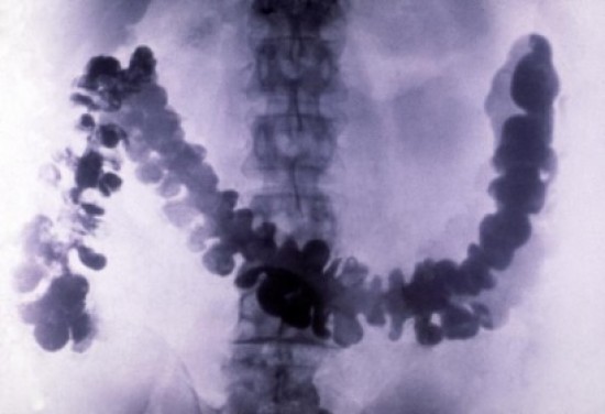 Kettős kontrasztos báriumos röntgenvizsgálat