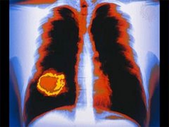 kissejtes tüdőrák hpv vírus orosz