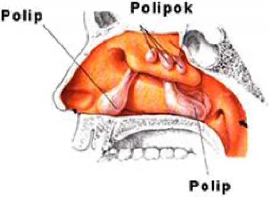 Polip - polyp