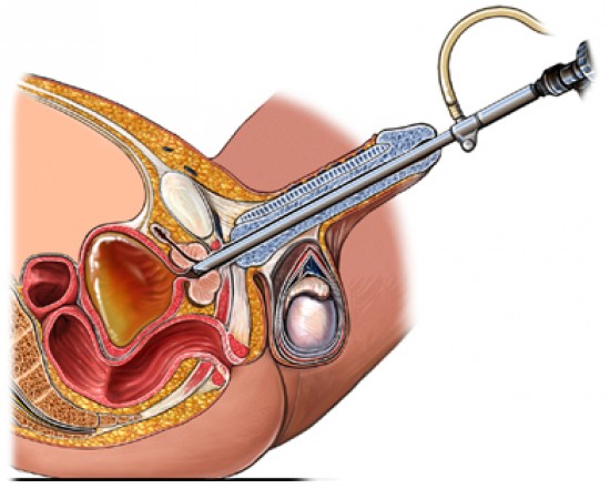 prosztatit katéter prostatitis és viszketés a hátsó részben