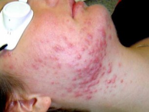 Seborrhoeás dermatitis kezelésére, okai, diéta, mindent allergia