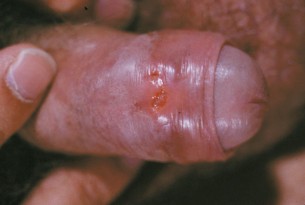  Egy tünetmentes nemi betegség jelei - Chlamydia a húgycsőben
