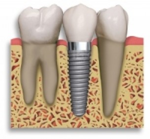 A fogimplantáció fajtái 