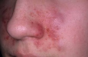 Diéta menü a seborrhea (seborrheás dermatitis) a fejbőr és az arc