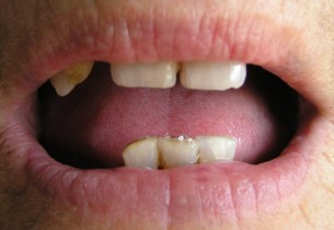Dominó-effektus: Ha nem pótolja időben a hiányzó fogait, rámehet az össze