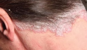 seborrhoeás dermatitis hajas fejbőrön)