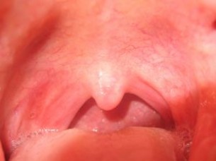 Fájdalmas összefüggés: Amikor a mandulagyulladás pikkelysömört provokál