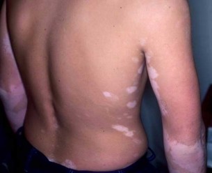 Fehér foltok a bőrön: Napgomba vagy vitiligo az oka?