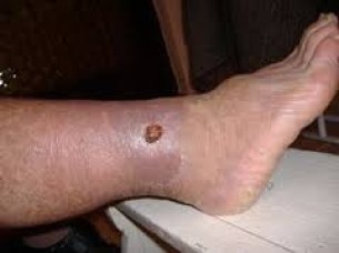 a kezelés a nyílt sebek a lábon diabéteszben a sebek diabetes mellitus kezelése