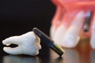 Fogpótlás: Összeköthető az implantátum a foggal?