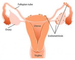 Hol kezelhető a krónikus endometriózis?