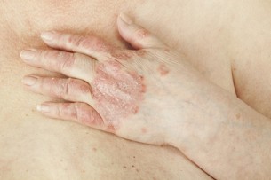 Krémtől a fényig - ezek a legjobb módszerek a viszkető bőrbetegség ellen