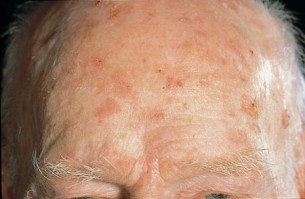Mik a bőrrák tünetei?