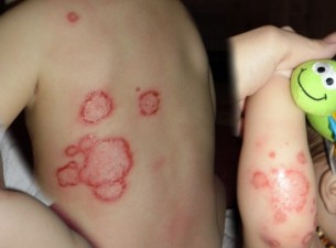 Pikkelysömör gyermekkorban: Így kezelik az ízületroncsoló bőrbetegséget