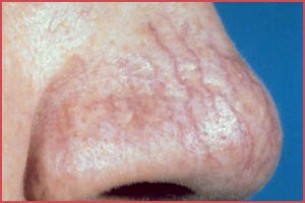 Táguló erek az arcon: a lappangó bőrbetegség biztos jelei
