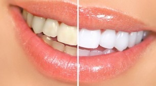 Vakító fehér fogak házilag?