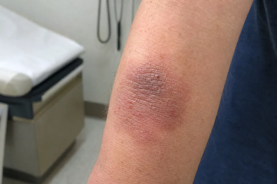 Neurodermatitis circumscripta (Bőrgyulladás) tünetei, okai, jelei, megelőzése, kezelése, gyógyítása