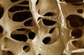 A csontritkulás okai és rizikófaktorai
