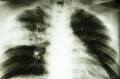 Egy régi kor letűntnek hitt betegsége: a tbc 