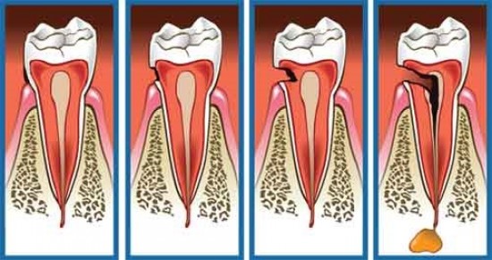 Fogszuvasodás megelőzése homeopátiával 