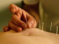 Valóban hatásos az akupunktúra? 