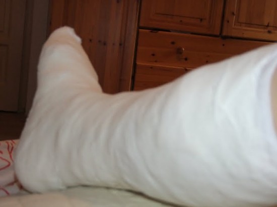 láb törések boka törés után fájdalom a vállízület osteochondrozisában