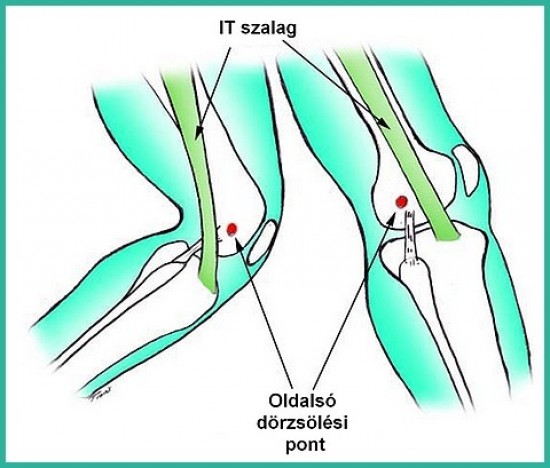 Fájó és ropogó kar- és lábízületek, Gyulladásos ízületi megbetegedések (arthritisek)