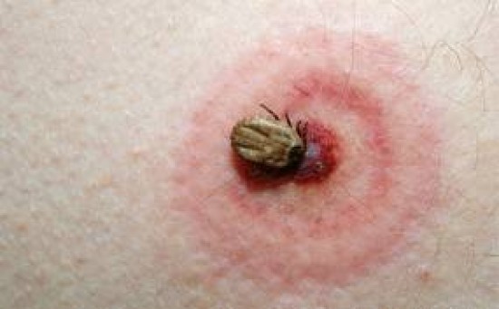 Fertőző betegségek - Lyme-kór
