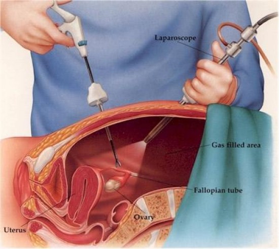 Szülészet-nőgyógyászat - Petefészek-ciszta gyógyítása laparoszkópos eljárással