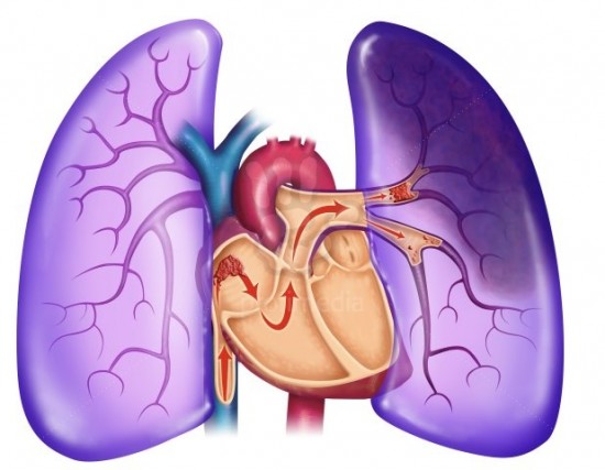 Tüdő- és légúti megbetegedések - Tüdőembólia