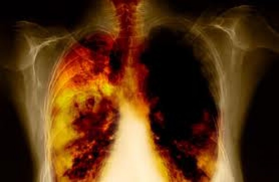 Tumoros megbetegedések - Tüdőrák