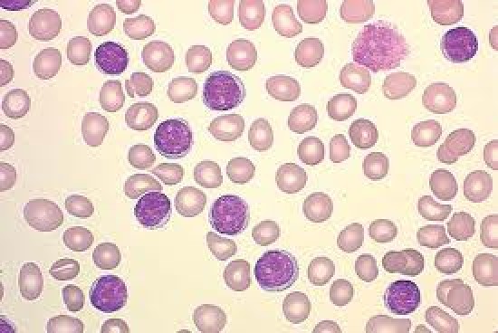 Absolute lymphocytosis