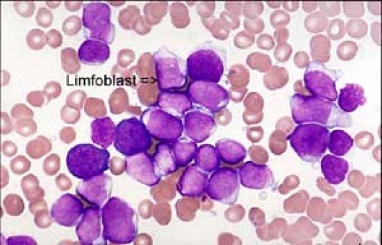 Acut leukemia