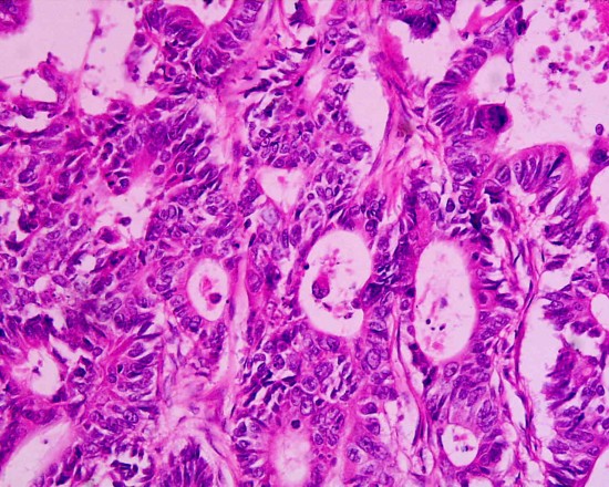 Adenocarcinoma