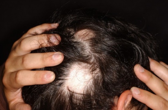 Alopecia