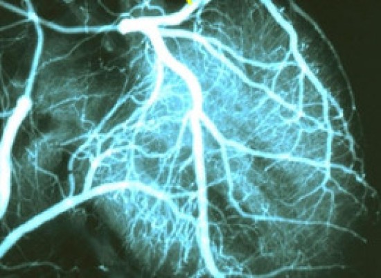 Angiogram