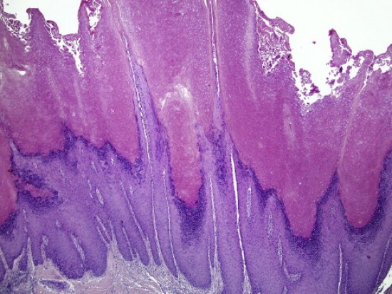 Epithelialis carcinoma