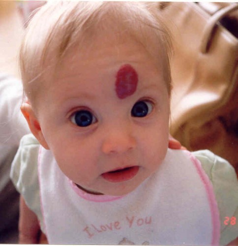 Hemangioma - haemangioma