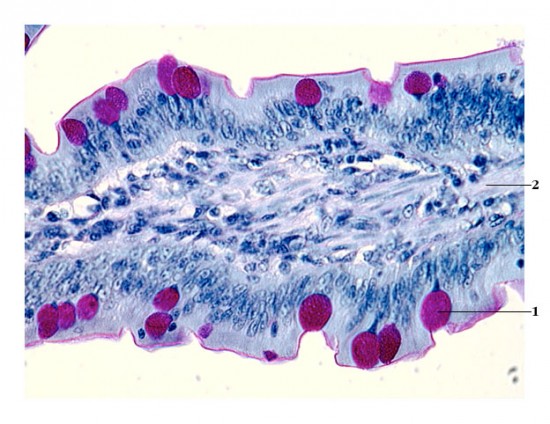 Intraepithelialis