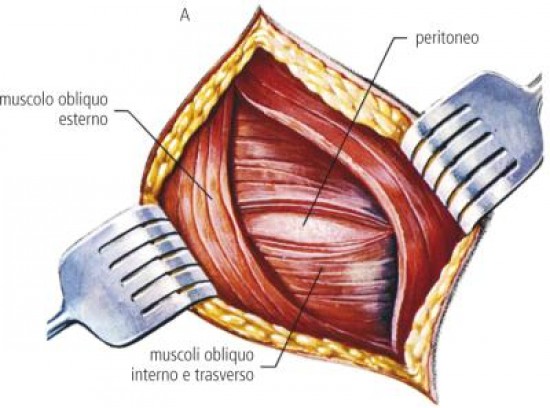 Laparotomia