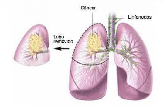 Lobektómia