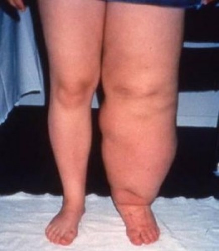 Lymphoedema - lymphedema