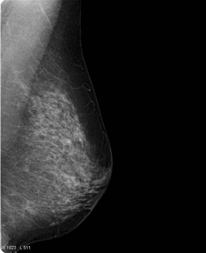 Mammogram